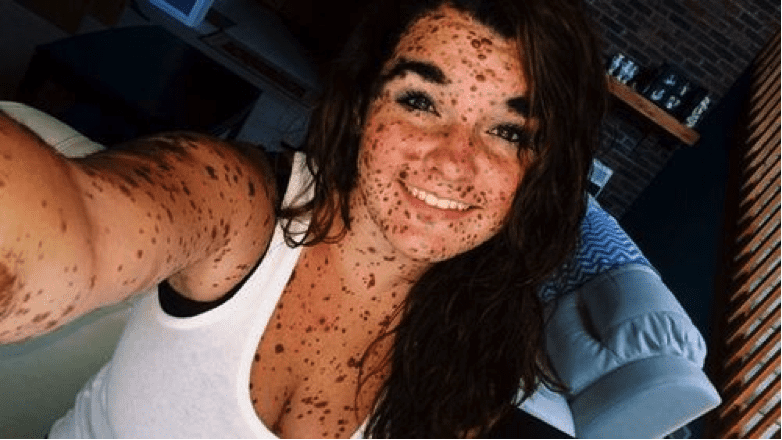 TrendMantra article_368_3 Inspiring: This Girl Was Bullied As A Kid For Her Birthmarks. Look At Her Transformation! 